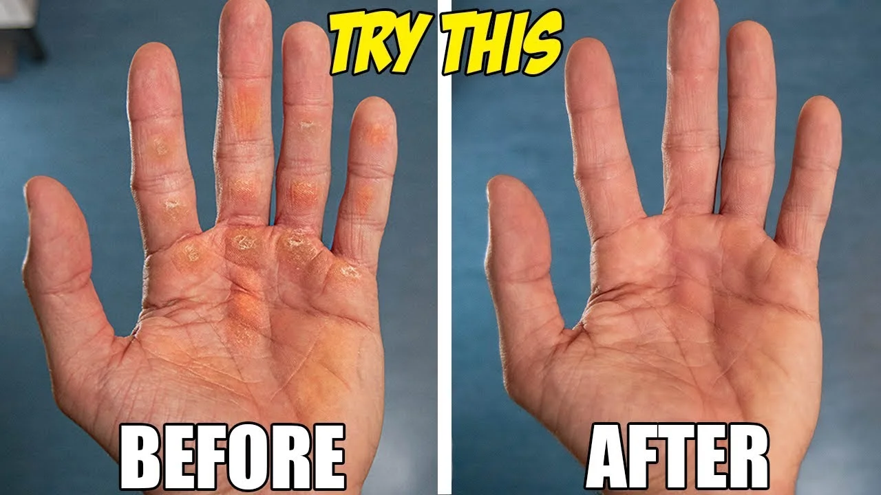 Hand Calluses Guide: How to Treat Them for Calisthenics